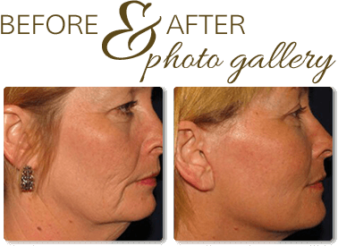 before after gallery
