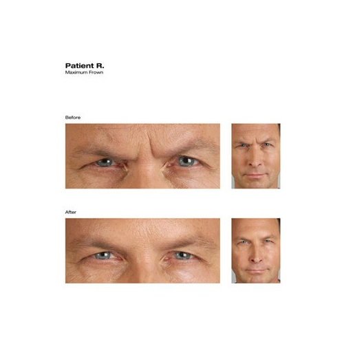 Before and After Image: Botox - front