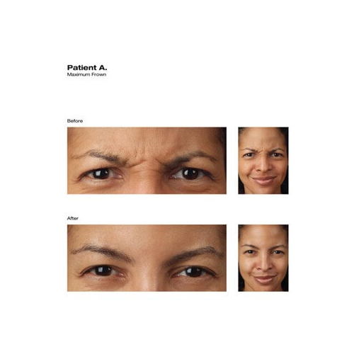 Before and After Image: Botox - front