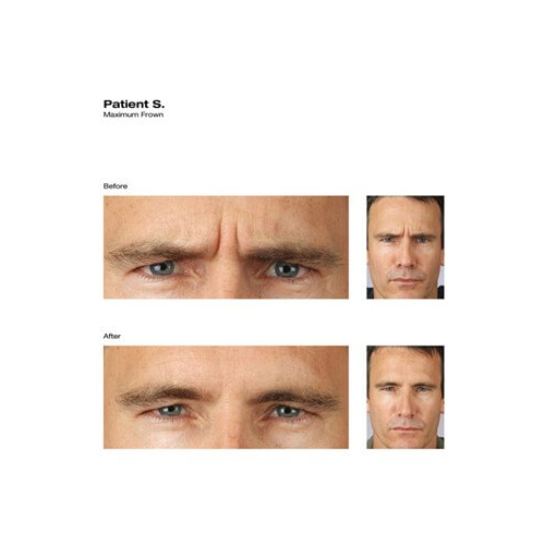 Before and After Image: Botox - front