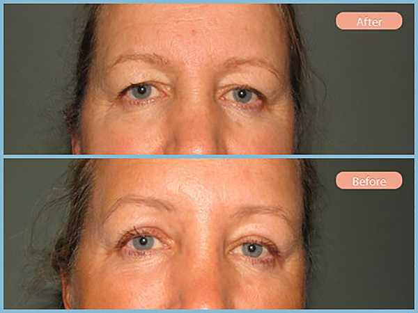 Before and After Image: Browlift and Upper Eyelid Blepharoplasty - front