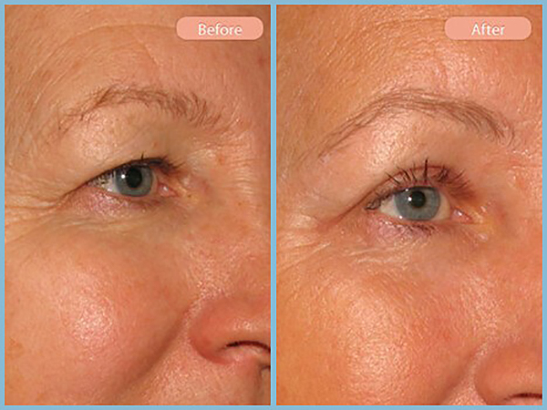 Before and After Image: Browlift and Upper Eyelid Blepharoplasty - right-front-oblique