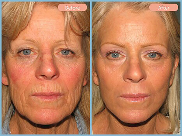 Before and After Image: Browlift and Upper Eyelid Blepharoplasty - front