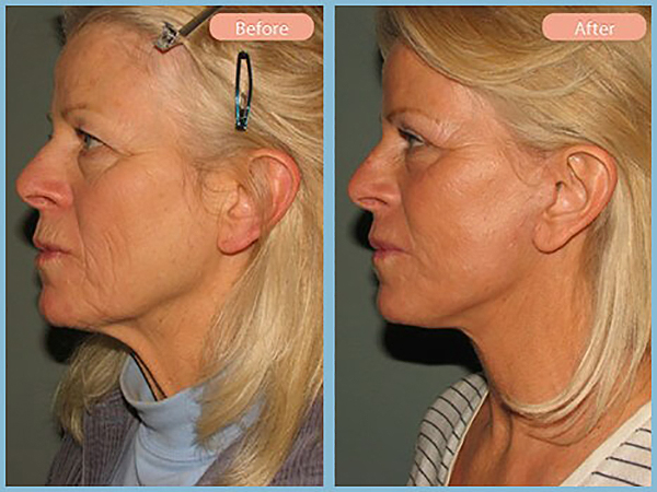 Before and After Image: Browlift and Upper Eyelid Blepharoplasty - left-side