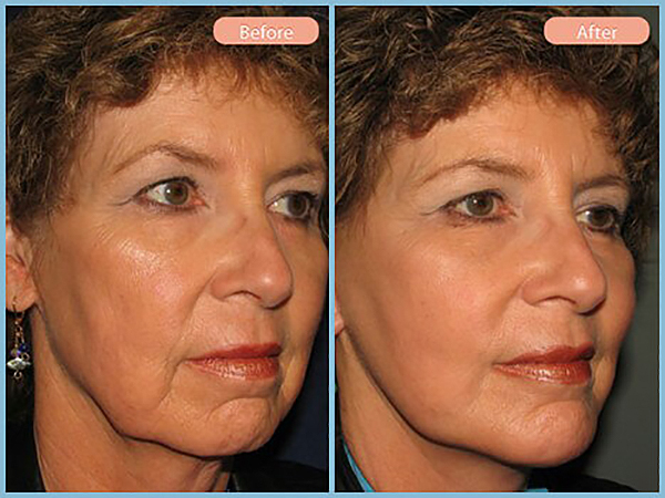 Before and After Image: Facelift and Chin Augmentation - right-front-oblique