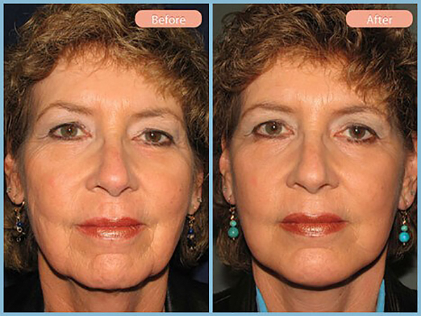 Before and After Image: Facelift and Chin Augmentation - front