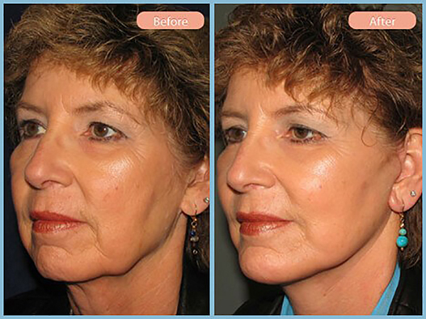 Before and After Image: Facelift and Chin Augmentation - left-front-oblique