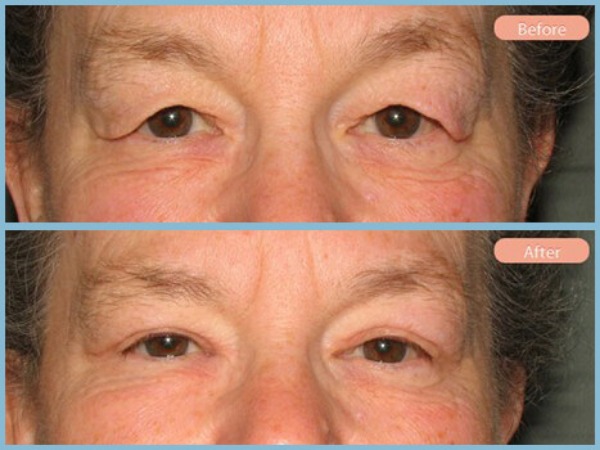 Before and After Image: Upper Eyelid Blepharoplasty