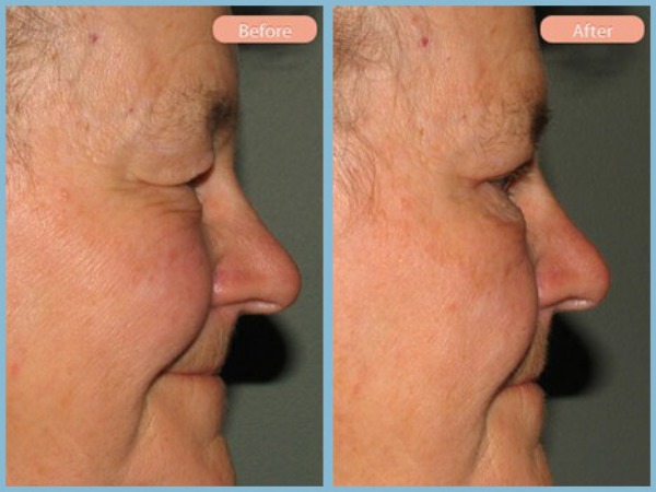 Before and After Image: Upper Eyelid Blepharoplasty - right-side