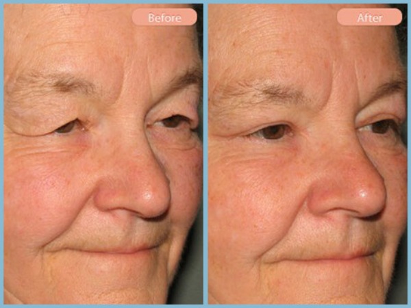 Before and After Image: Upper Eyelid Blepharoplasty - right-front-oblique