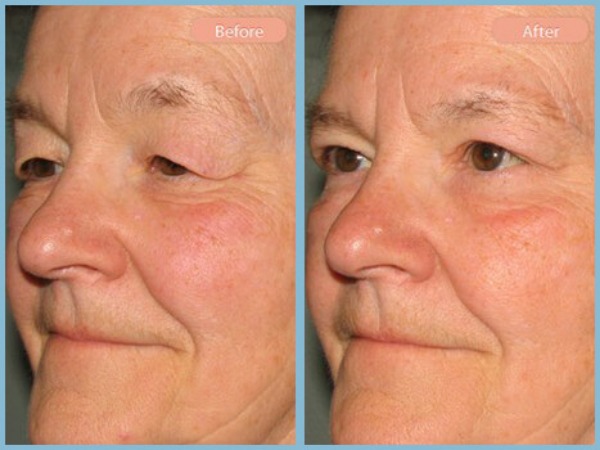 Before and After Image: Upper Eyelid Blepharoplasty - left-front-oblique
