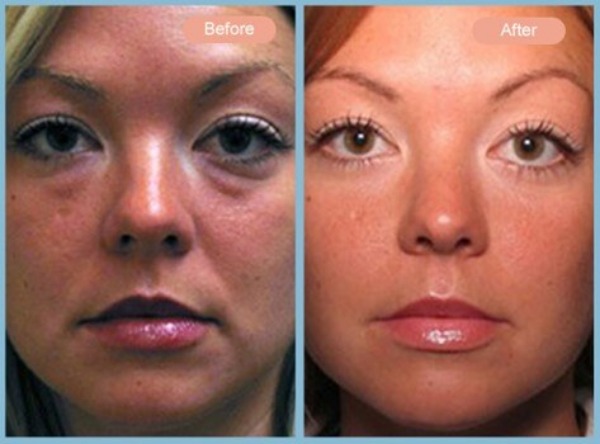 Before and After Image: Lower Eyelid Blepharoplasty - front