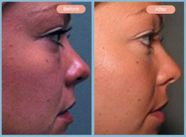 Before and After Image: Lower Eyelid Blepharoplasty - right-side