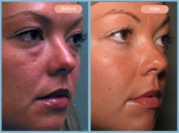 Before and After Image: Lower Eyelid Blepharoplasty - right-front-oblique