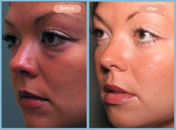 Before and After Image: Lower Eyelid Blepharoplasty - left-front-oblique