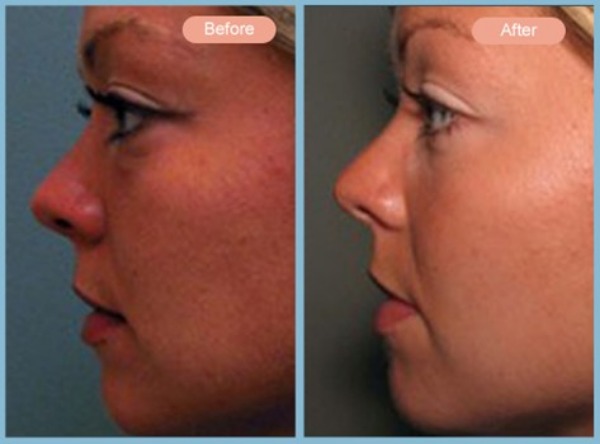 Before and After Image: Lower Eyelid Blepharoplasty - left-side