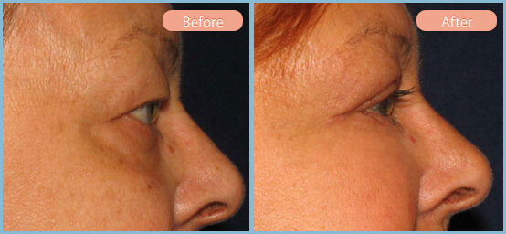 Before and After Image: Upper and Lower Eyelid Blepharoplasties - right-side