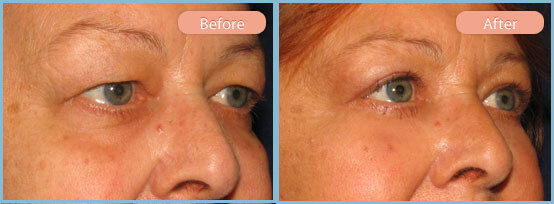 Before and After Image: Upper and Lower Eyelid Blepharoplasties - right-front-oblique