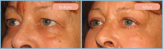 Before and After Image: Upper and Lower Eyelid Blepharoplasties - left-front-oblique