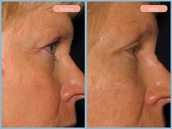Before and After Image: Browlift and Upper Eyelid Blepharoplasty