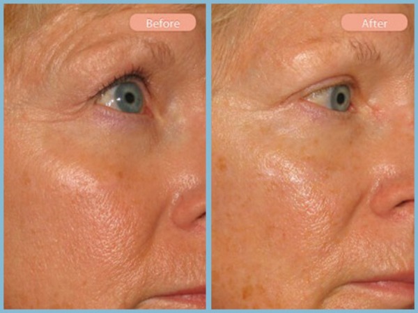 Before and After Image: Browlift and Upper Eyelid Blepharoplasty - right-front-oblique