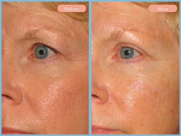 Before and After Image: Browlift and Upper Eyelid Blepharoplasty - left-front-oblique