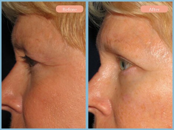 Before and After Image: Browlift and Upper Eyelid Blepharoplasty - left-side