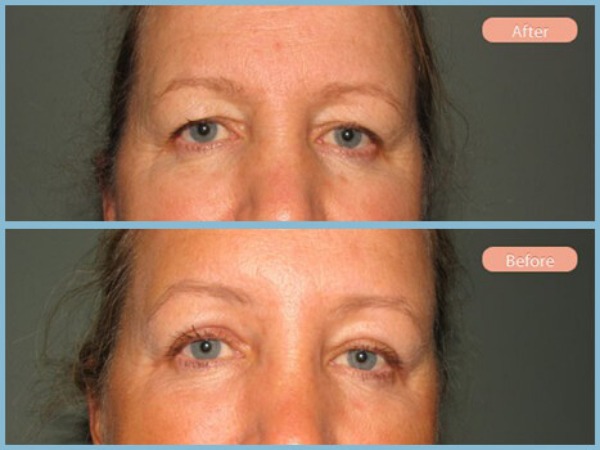 Before and After Image: Browlift and Upper Eyelid Blepharoplasty - front