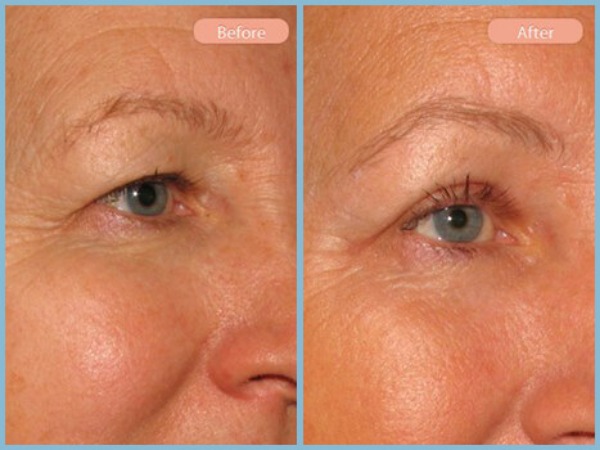 Before and After Image: Browlift and Upper Eyelid Blepharoplasty - right-front-oblique