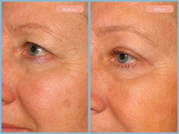 Before and After Image: Browlift and Upper Eyelid Blepharoplasty - left-front-oblique