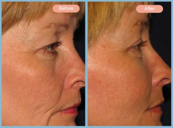 Before and After Image: Facelift, Neck Liposuction and Upper Eyelid Blepharoplasty - right-side