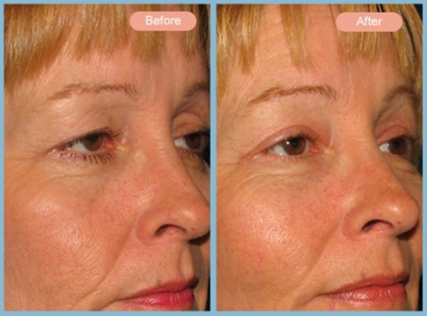 Before and After Image: Facelift, Neck Liposuction and Upper Eyelid Blepharoplasty - right-front-oblique
