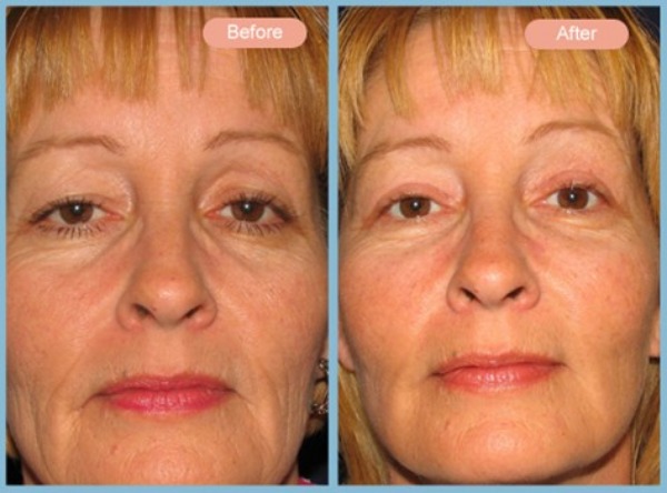 Before and After Image: Facelift, Neck Liposuction and Upper Eyelid Blepharoplasty - front