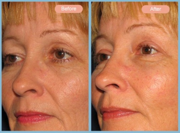 Before and After Image: Facelift, Neck Liposuction and Upper Eyelid Blepharoplasty - left-front-oblique