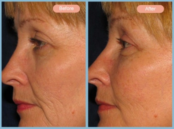 Before and After Image: Facelift, Neck Liposuction and Upper Eyelid Blepharoplasty - left-side