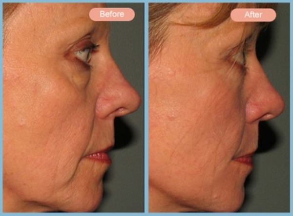 Before and After Image: Facelift and Lower Eyelid Blepharoplasty - right-side