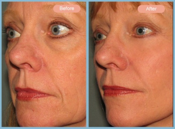 Before and After Image: Facelift and Lower Eyelid Blepharoplasty - left-front-oblique
