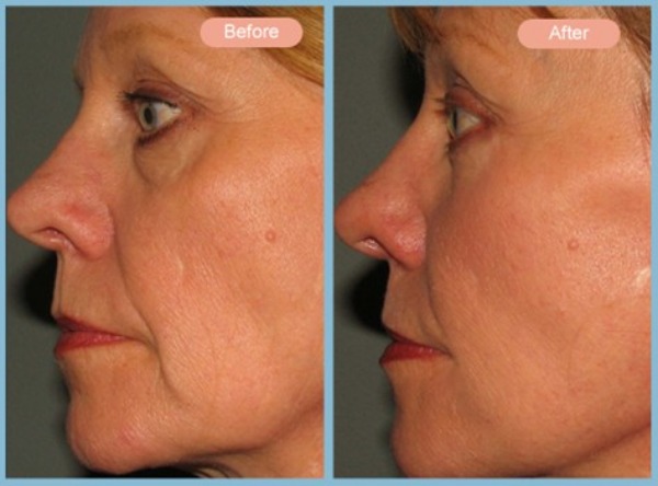 Before and After Image: Facelift and Lower Eyelid Blepharoplasty - left-side