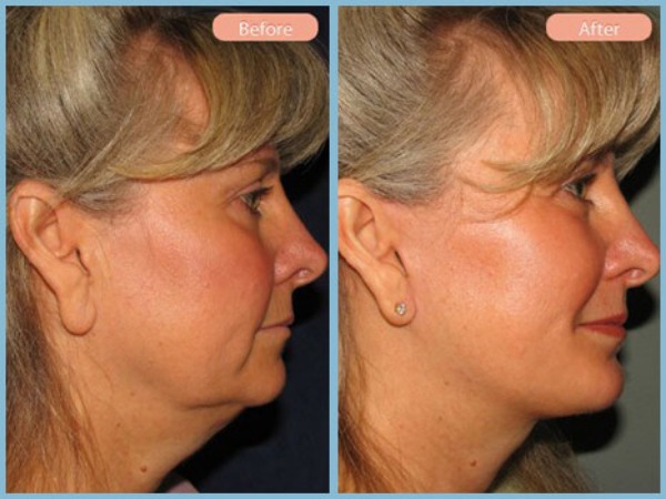 Before and After Image: Facelift and Neck Liposuction