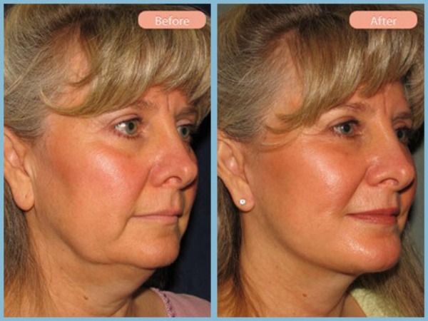Before and After Image: Facelift and Neck Liposuction - right-front-oblique