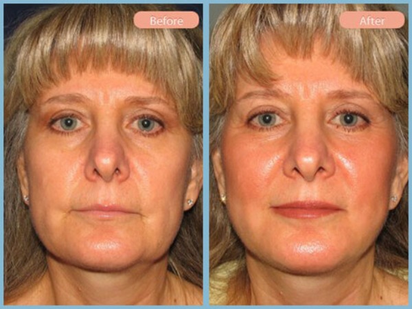 Before and After Image: Facelift and Neck Liposuction - front
