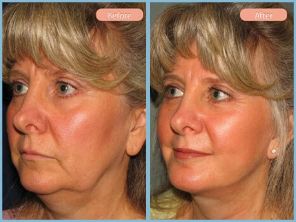 Before and After Image: Facelift and Neck Liposuction - left-front-oblique