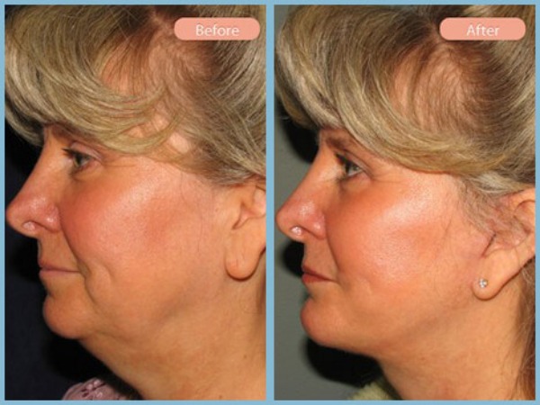 Before and After Image: Facelift and Neck Liposuction - left-side