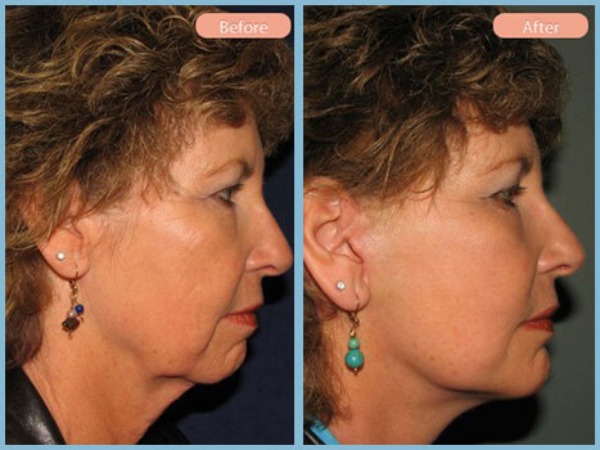 Before and After Image: Facelift and Chin Augmentation