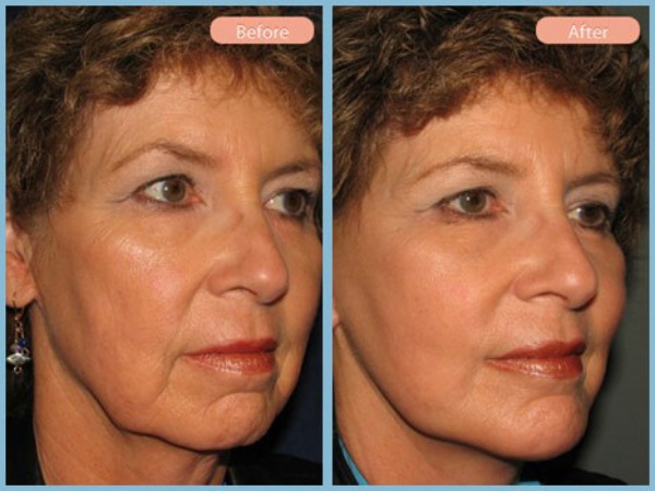 Before and After Image: Facelift and Chin Augmentation - right-front-oblique