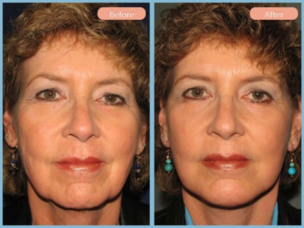 Before and After Image: Facelift and Chin Augmentation -