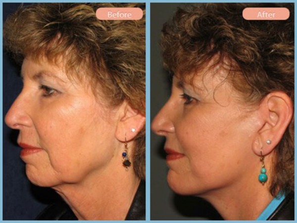 Before and After Image: Facelift and Chin Augmentation - left-side