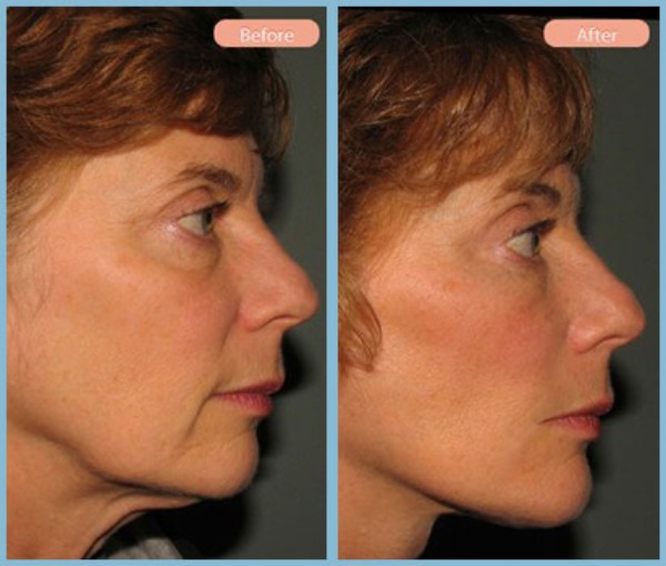 Before and After Image: Facelift