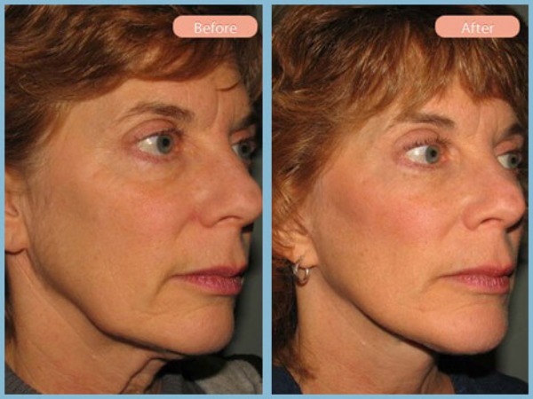 Before and After Image: Facelift - right-front-oblique