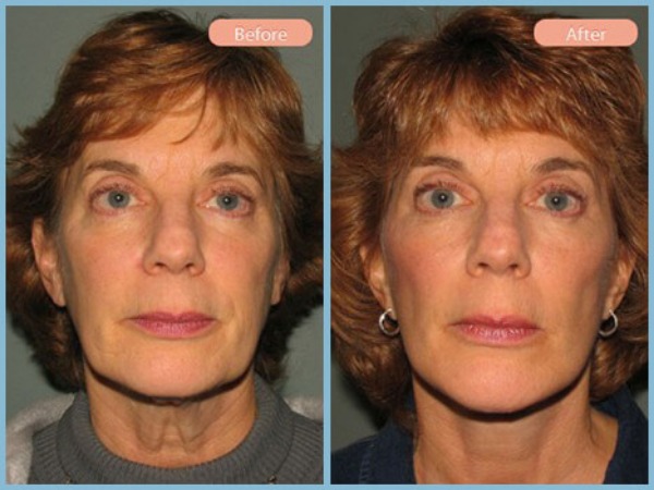Before and After Image: Facelift - front